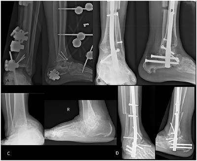 Outcome of Pantalar Fusion With Femoral Head Allograft in Avascular Necrosis of Talus